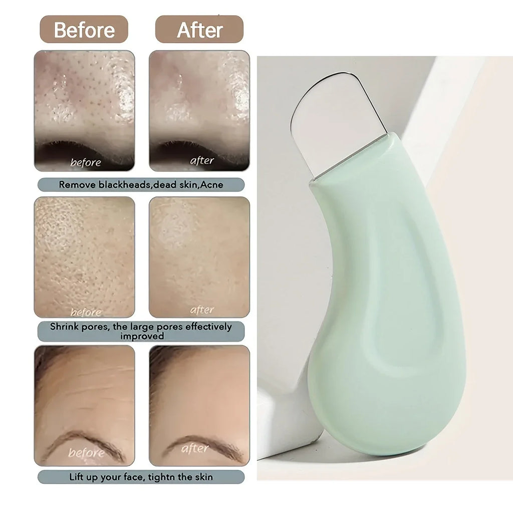 Blackhead & Whitehead Removal Tool – Nose & Face, Pore Cleaner for Women