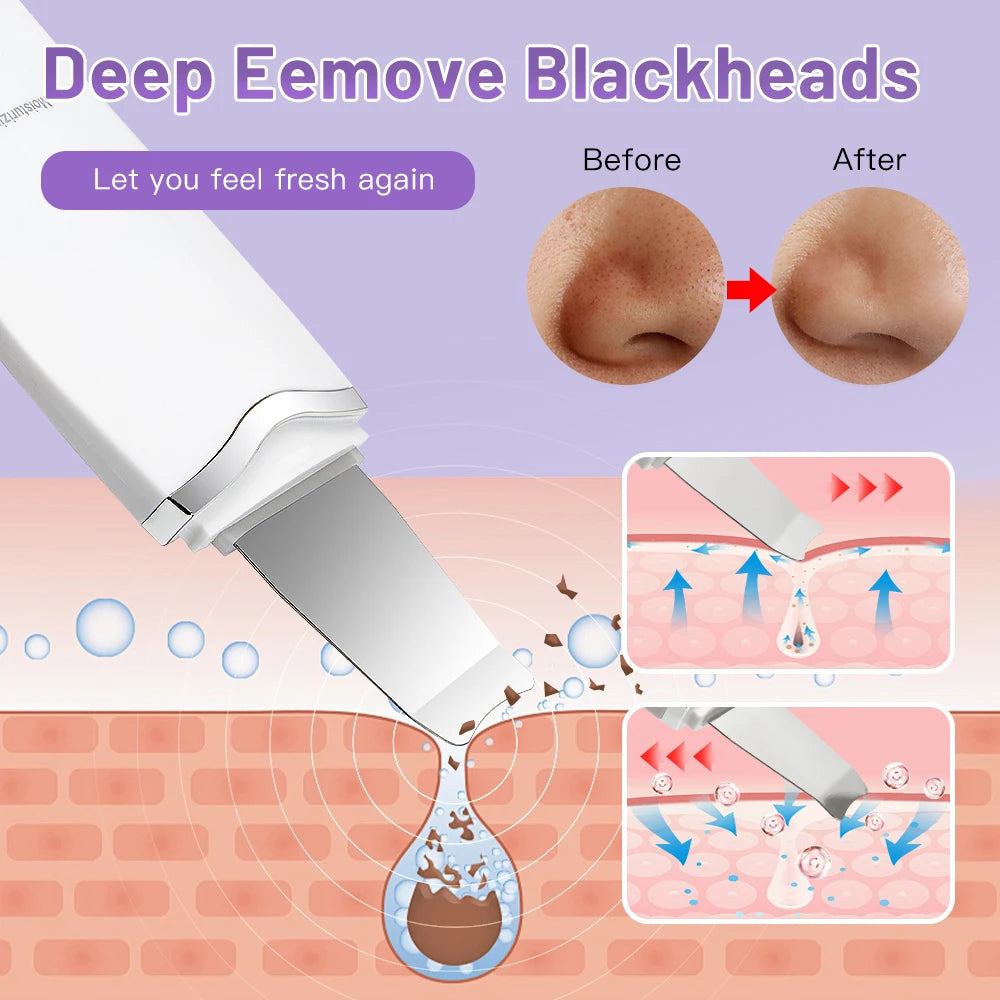 Ultrasonic Skin Scrubber – Electric Face Spatula, Peeling, Blackhead Removal & Facial Lifting