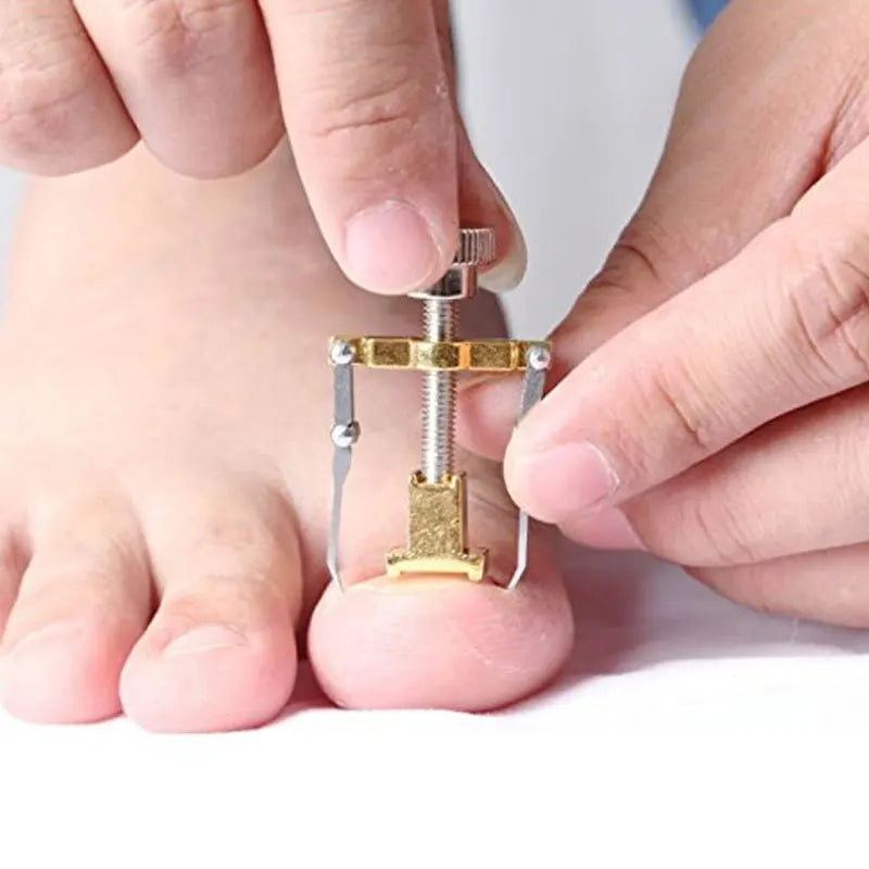 Tcare Ingrown Toenail Corrector – Pedicure Tool, Straightening Clip & Brace for Toe Nail Care