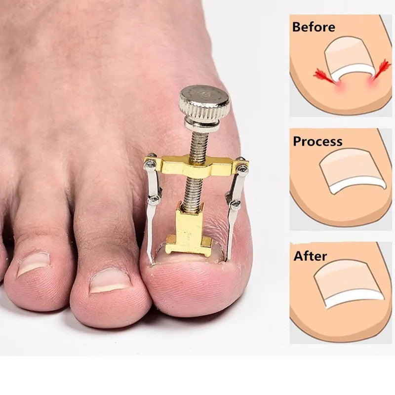 Tcare Ingrown Toenail Corrector – Pedicure Tool, Straightening Clip & Brace for Toe Nail Care